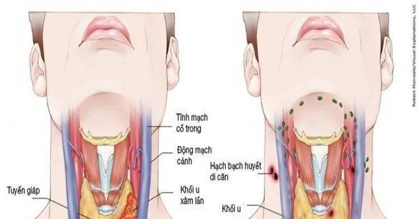 Tổng hợp 98+ hình về mô hình cuống họng - NEC