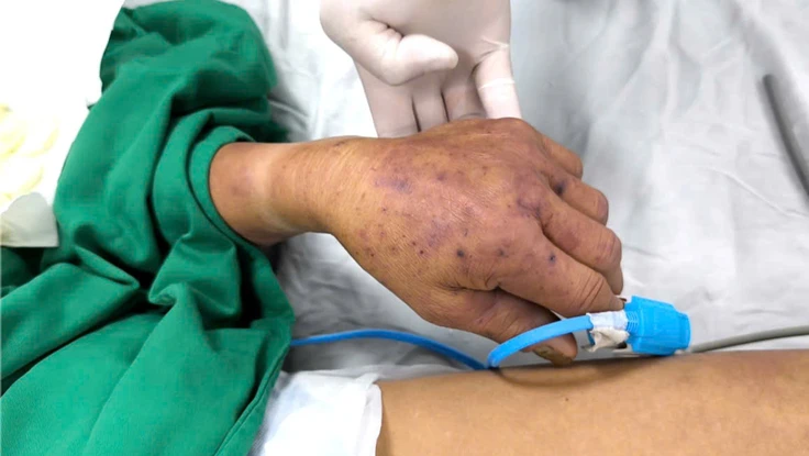 Hà Nội ghi nhận ca đầu tiên tử vong do liên cầu lợn