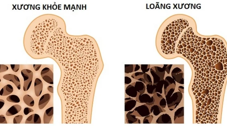 Ăn gì để đề phòng thiếu canxi?
