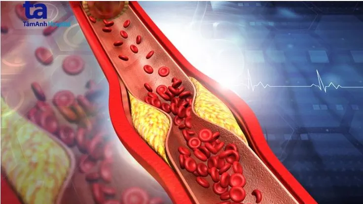 Những cách kiểm soát mỡ máu ở người cao tuổi