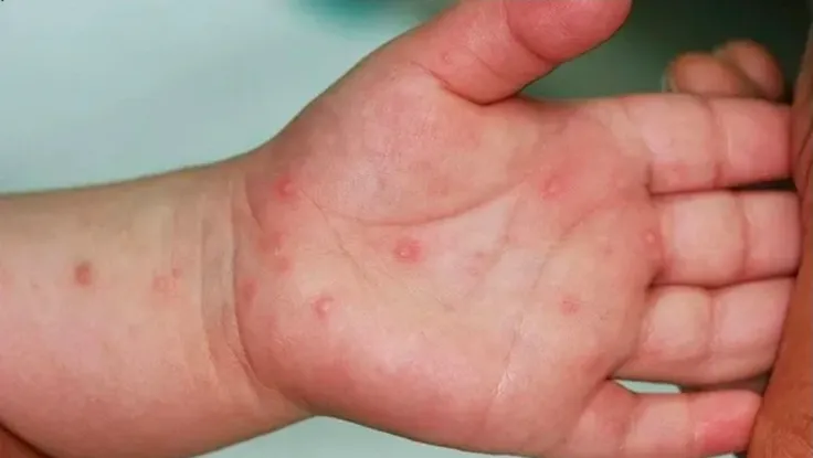 TP.HCM cảnh báo tác nhân EV71 gây bệnh tay chân miệng nặng xuất hiện trở lại