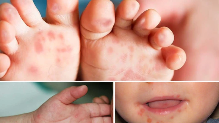 Bộ Y tế ra công văn hỏa tốc trước diễn biến phức tạp của bệnh tay chân miệng