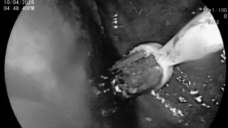 Nam thanh niên nuốt 3 bàn chải đánh răng