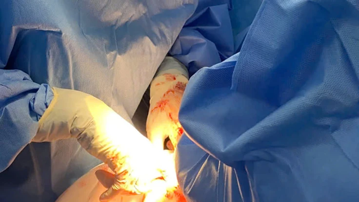 Thai phụ đau bụng bất thường, nguy kịch vì u buồng trứng xoắn hoại tử