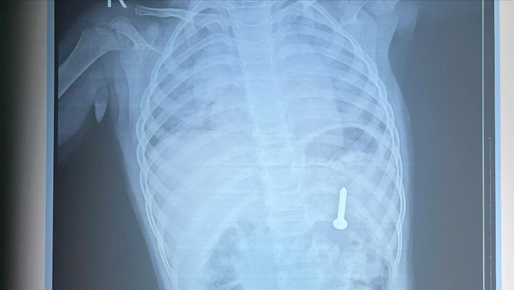 Nội soi gắp đinh vít trong dạ dày bé 21 tháng tuổi