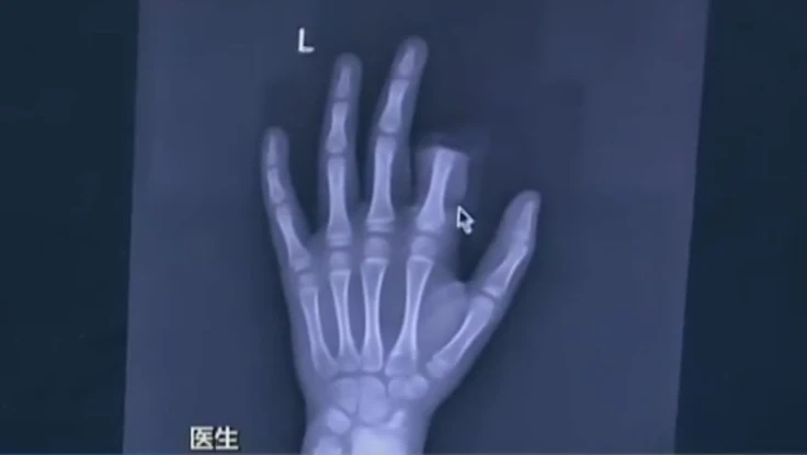 Tự cắt ngón tay vì bị cấm xài smartphone