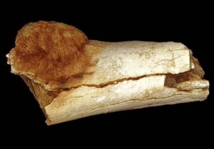Ung thư đã có cách đây ít nhất 1,7 triệu năm trước?