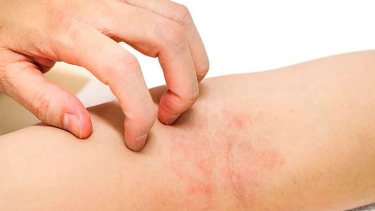 Cách chăm sóc đúng cho người bị viêm da cơ địa