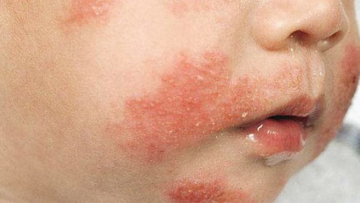Cảnh báo dị ứng đạm sữa bò