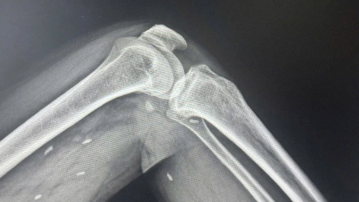 Phát hiện nhiều kén sán trong cơ thể người đàn ông thích ăn đồ sống