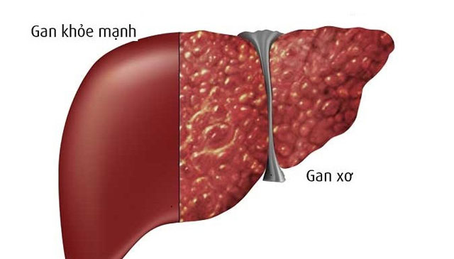 Sức khỏe, đời sống: Dấu hiệu nhận biết xơ gan, ung thư gan giai đoạn cuối Gan-xo_piau