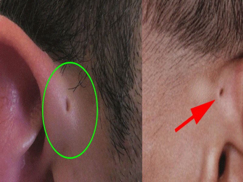 Rò luân nhĩ: Chớ có coi thường!