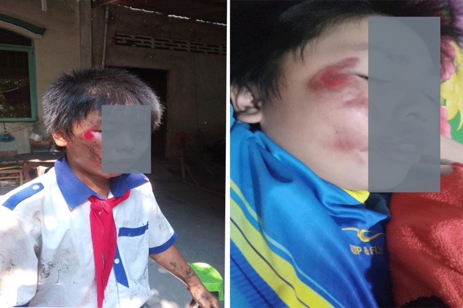 Nam sinh lớp 6 bị bạn học cùng lớp xô xe, té ngã trầy xước ở mặt. Ảnh: FB Mâu thuẫn học đường, nam sinh lớp 6 bị bạn cùng lớp xô đẩy ngã xe bị thương