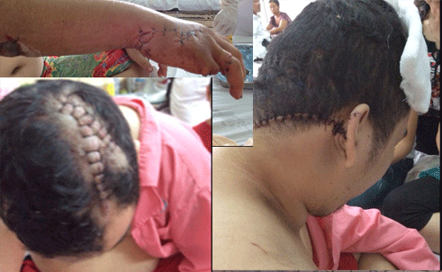 Anh Bình với hàng chục vết thương khắp cơ thể và ngón tay út đã bị đứt lìa. Nhập mô tả cho ảnh