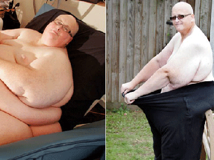 Người đàn ông mập nhất thế giới muốn cắt bỏ da ảnh 1