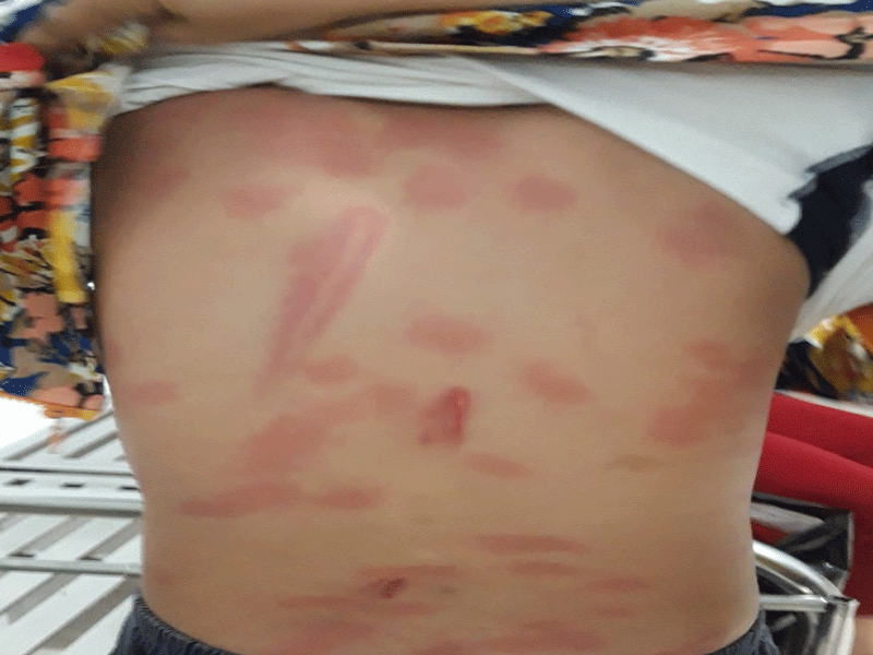 Bé trai 13 tuổi nghi bị cô ruột đánh bầm lưng phải nhập viện 