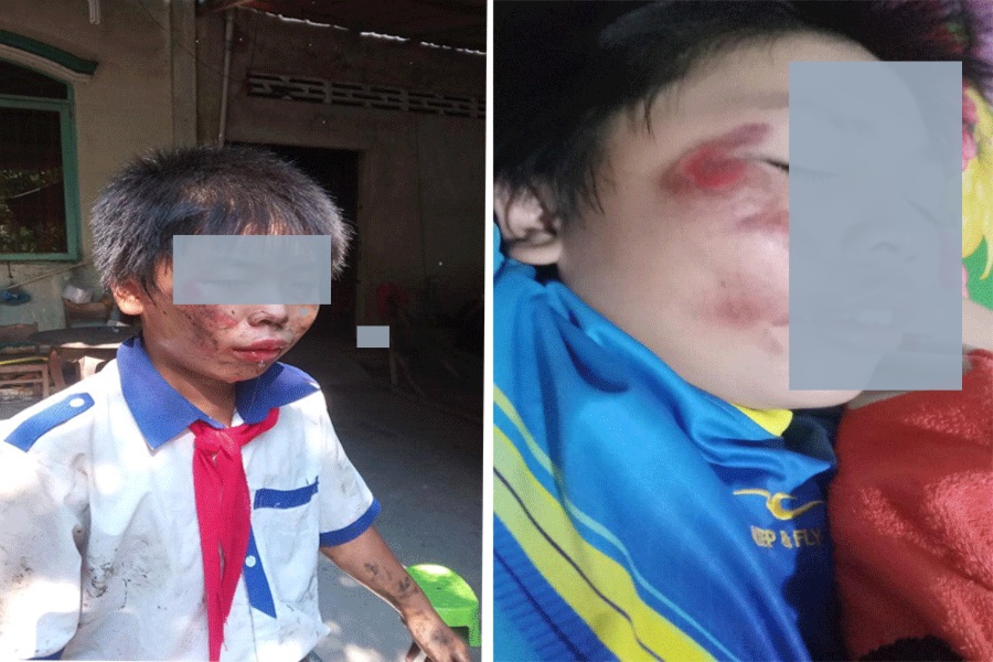 Mâu thuẫn học đường, nam sinh lớp 6 bị bạn cùng lớp xô đẩy ngã xe bị thương