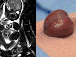 Phẫu thuật cho bé có trái tim ngoài lồng ngực ảnh 1 Phẫu thuật cho bé có trái tim ngoài lồng ngực ảnh 1