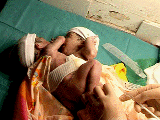 Một sản phụ đẻ sinh đôi dính liền nhau, không hậu môn ảnh 1