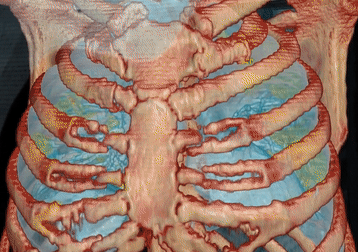 Video 3D cho thấy mức độ hủy hoại phổi của COVID-19