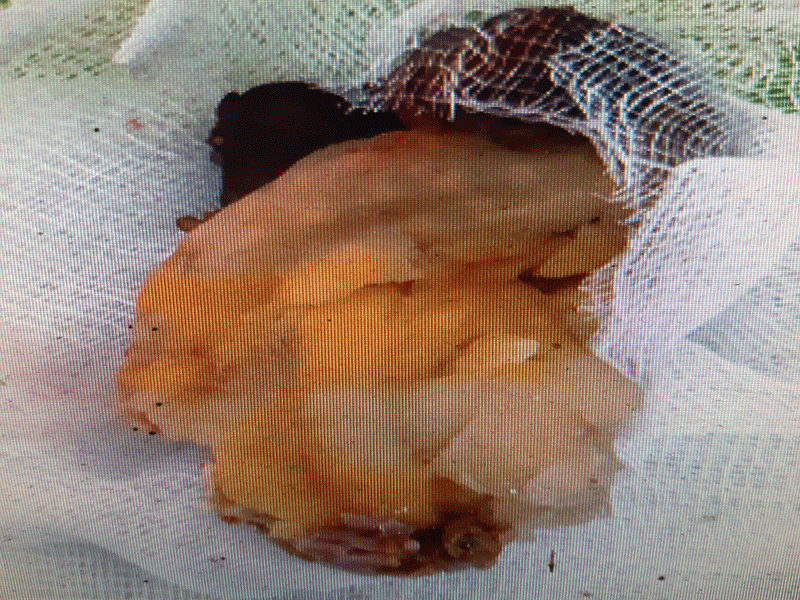 Vô ý nuốt phao câu vịt, ông 69 tuổi nhập viện cấp cứu