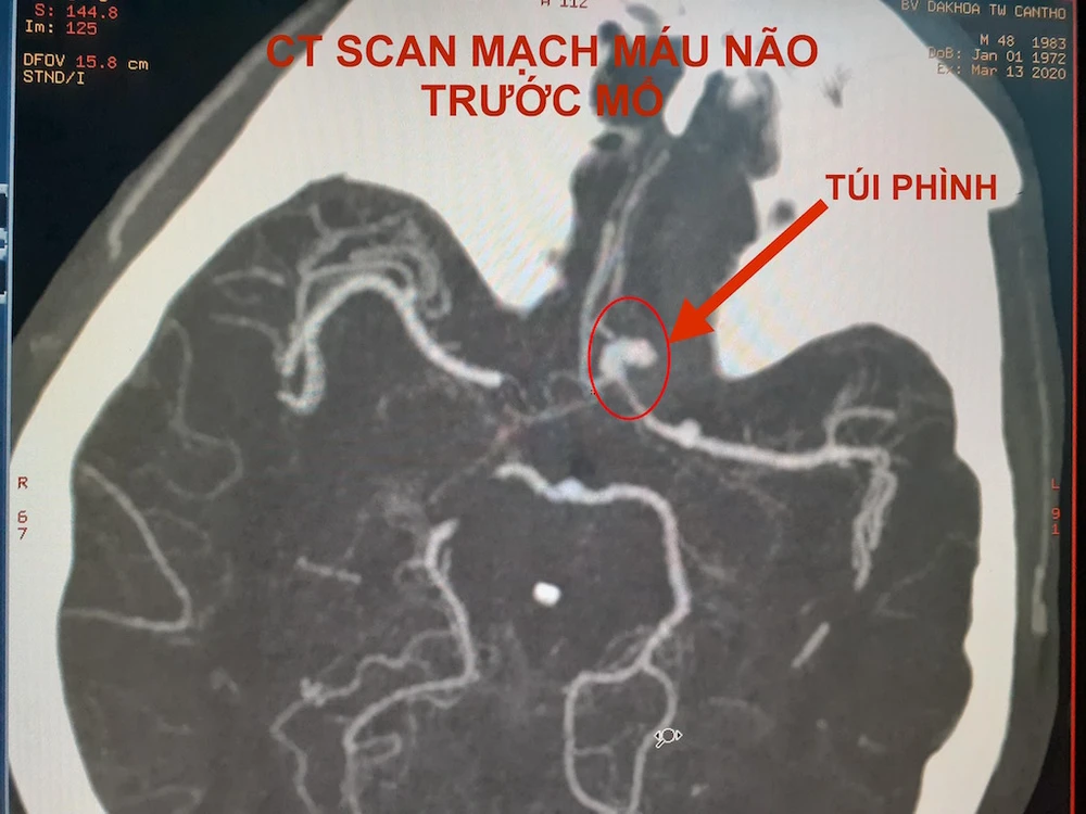 Hình ảnh CT Scan mạch máu não trước và sau vi phẫu kẹp túi phình. Ảnh: HẢI DƯƠNG 1