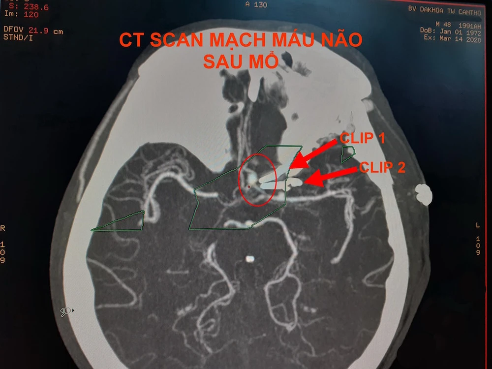 Hình ảnh CT Scan mạch máu não trước và sau vi phẫu kẹp túi phình. Ảnh: HẢI DƯƠNG 2
