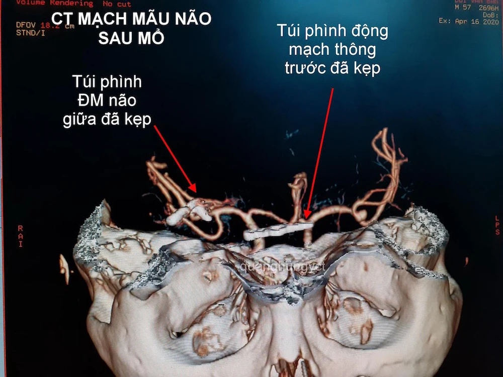 Hình ảnh CT Scan mạch máu não trước và sau can thiệp. Ảnh: HẢI DƯƠNG 2