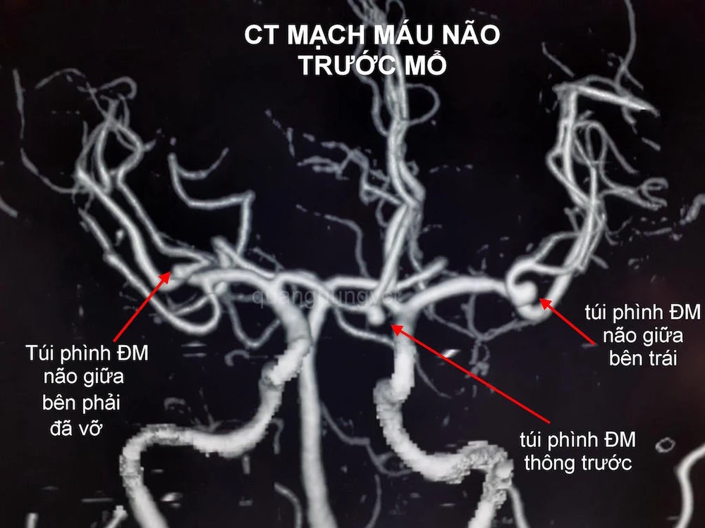 Hình ảnh CT Scan mạch máu não trước và sau can thiệp. Ảnh: HẢI DƯƠNG 1