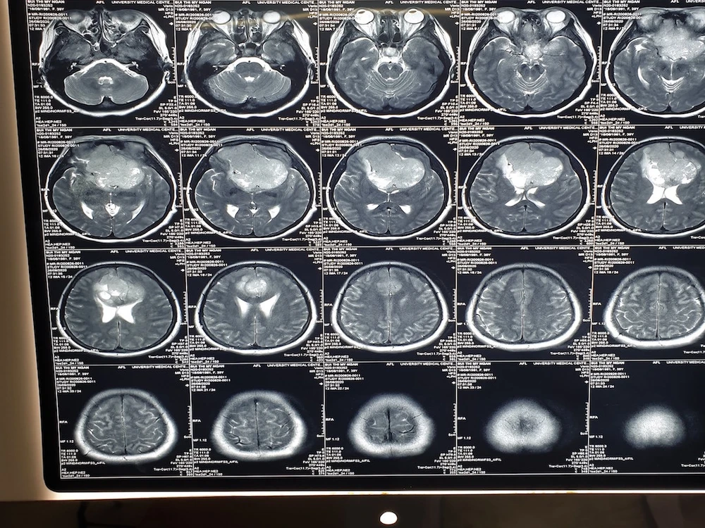 Khối u qua ảnh chụp MRI và các bác sĩ đang tiến hành phẫu thuật cắt khối u qua kính hiển vi. Ảnh: HD 1