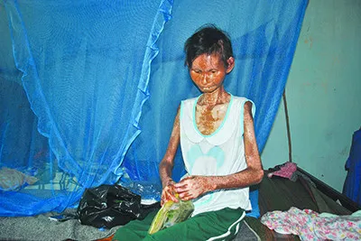 Người phụ nữ 34 tuổi mắc 'bệnh lạ', héo mòn như một bà cụ 'da bọc xương' - Ảnh 1 Nguoi phu nu 34 tuoi mac 'benh la', heo mon nhu mot ba cu 'da boc xuong' - Anh 1