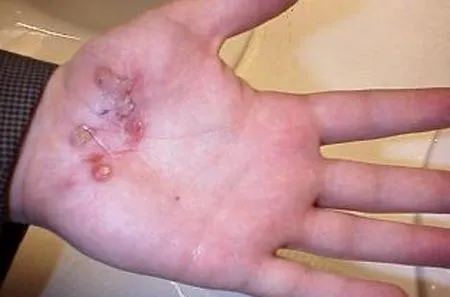 vi khuẩn, ăn thịt người, mầm bệnh, nguy hiểm, dịch bệnh