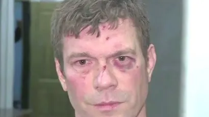 Thương tích trên mặt của ứng cử viênOleg Tsarev sau khi bị đám đông tấn công Thương tích trên mặt của ứng cử viênOleg Tsarev sau khi bị đám đông tấn công