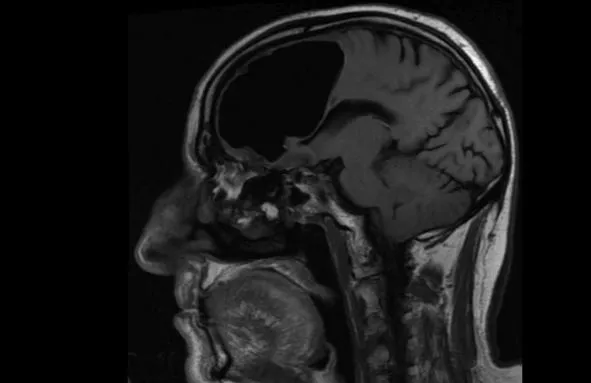  Bác sĩ sốc với người đàn ông 'thất lạc' 1/4 bộ não ảnh 2