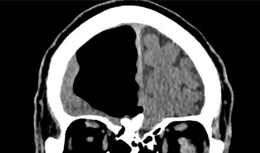  Bác sĩ sốc với người đàn ông 'thất lạc' 1/4 bộ não ảnh 1
