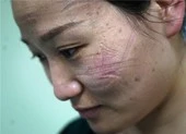 Bác sĩ Vũ Hán mặt hằn vết khẩu trang, đóng tã khi làm việc