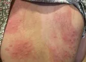Biển Đà Nẵng an toàn, vậy nguyên nhân gây ngứa là gì? ảnh 4 Đà Nẵng: Lấy mẫu nước, truy nguyên nhân gây ngứa sau tắm biển