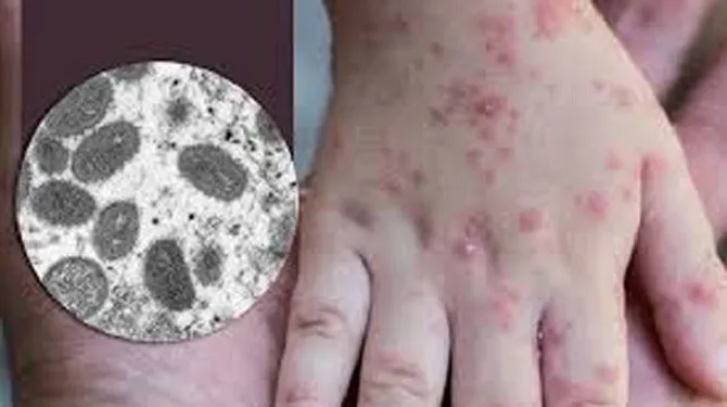 Một trong những biểu hiện của bệnh đậu mùa khỉ là phát ban. Ảnh minh họa: PLO đà nẵng đậu mùa khỉ âm tính