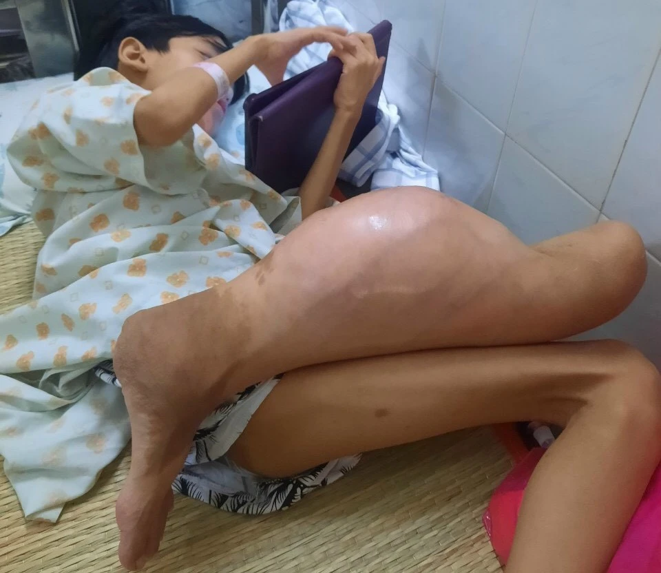 Em Đạt mới 12 tuổi đã mắc căn bệnh ung thư quái ác. Hình ảnh chụp trước khi em phải tháo khớp gối trái. Ảnh: NTCC ung thư đà nẵng năm sinh