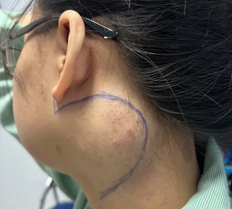 Khối u ở cổ sưng phồng từng khiến bệnh nhân mất tự tin