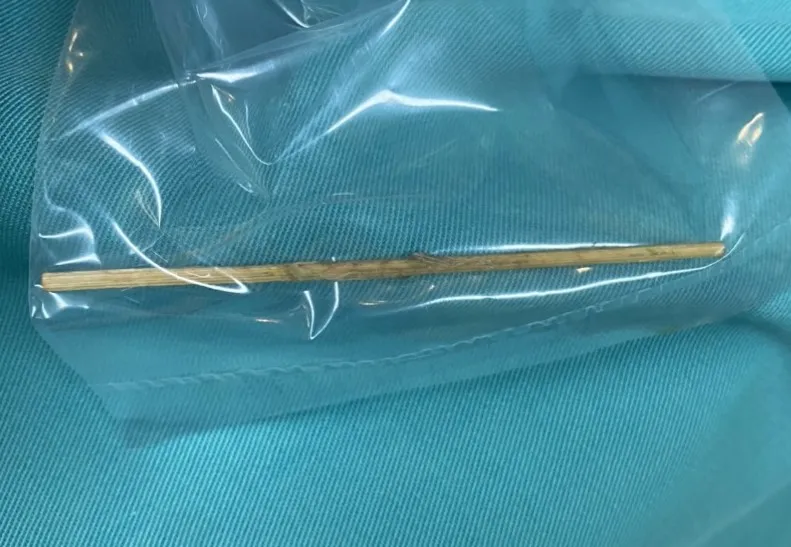 Nuốt tăm tre 10cm, người đàn ông bị đâm thủng đại tràng. Ảnh: BVCC nuot-tam-tre.jpg
