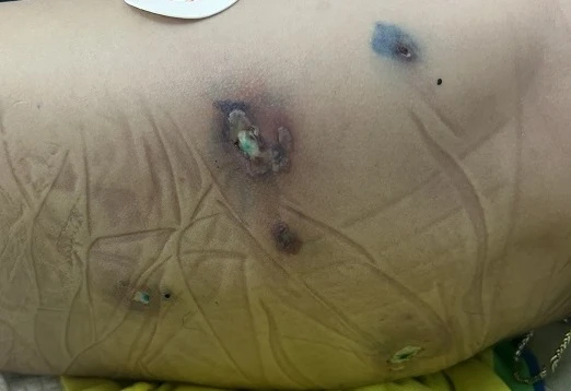 Sốc nhiễm khuẩn