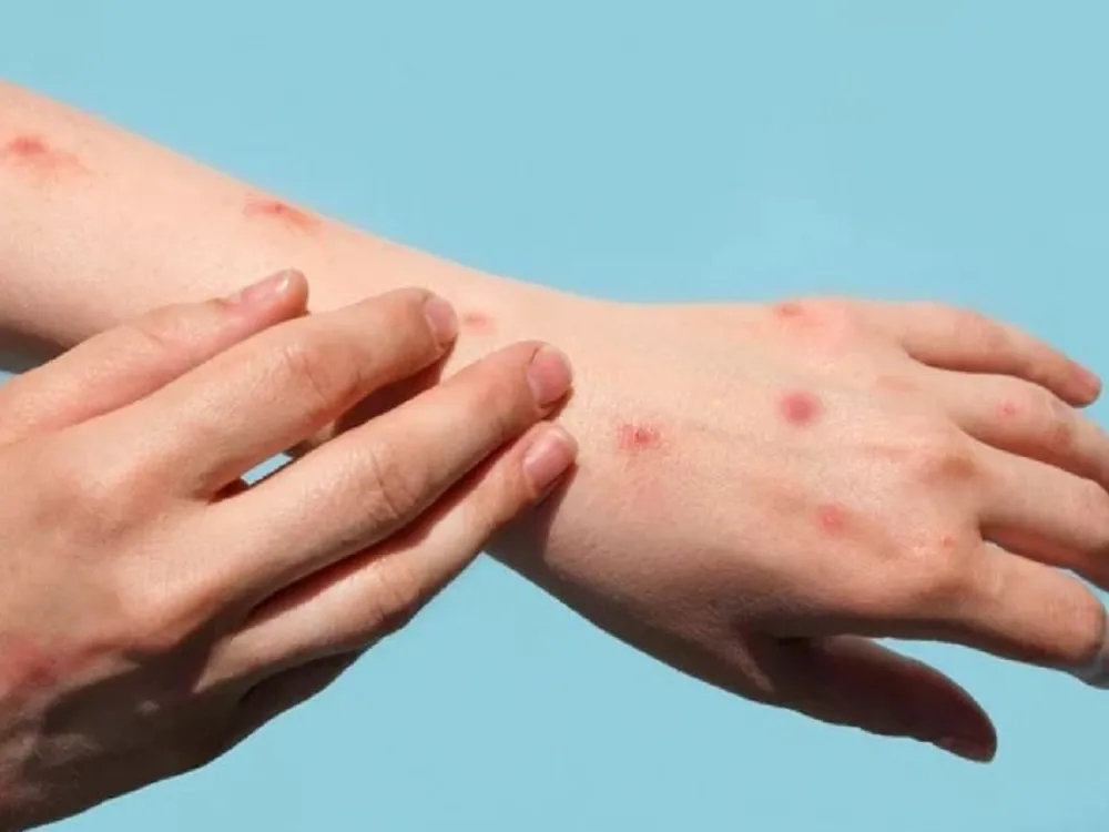 Việt Nam ghi nhận 56 ca đậu mùa khỉ, phần lớn đều đang nhiễm HIV. Ảnh minh họa đậu mùa khỉ