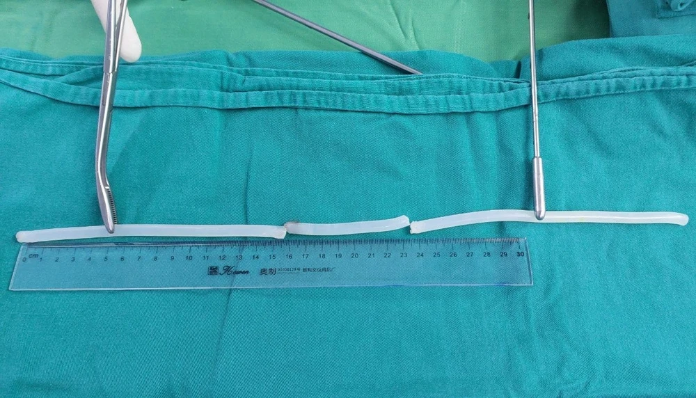 nhét dị vật vào niệu đạo.jpg