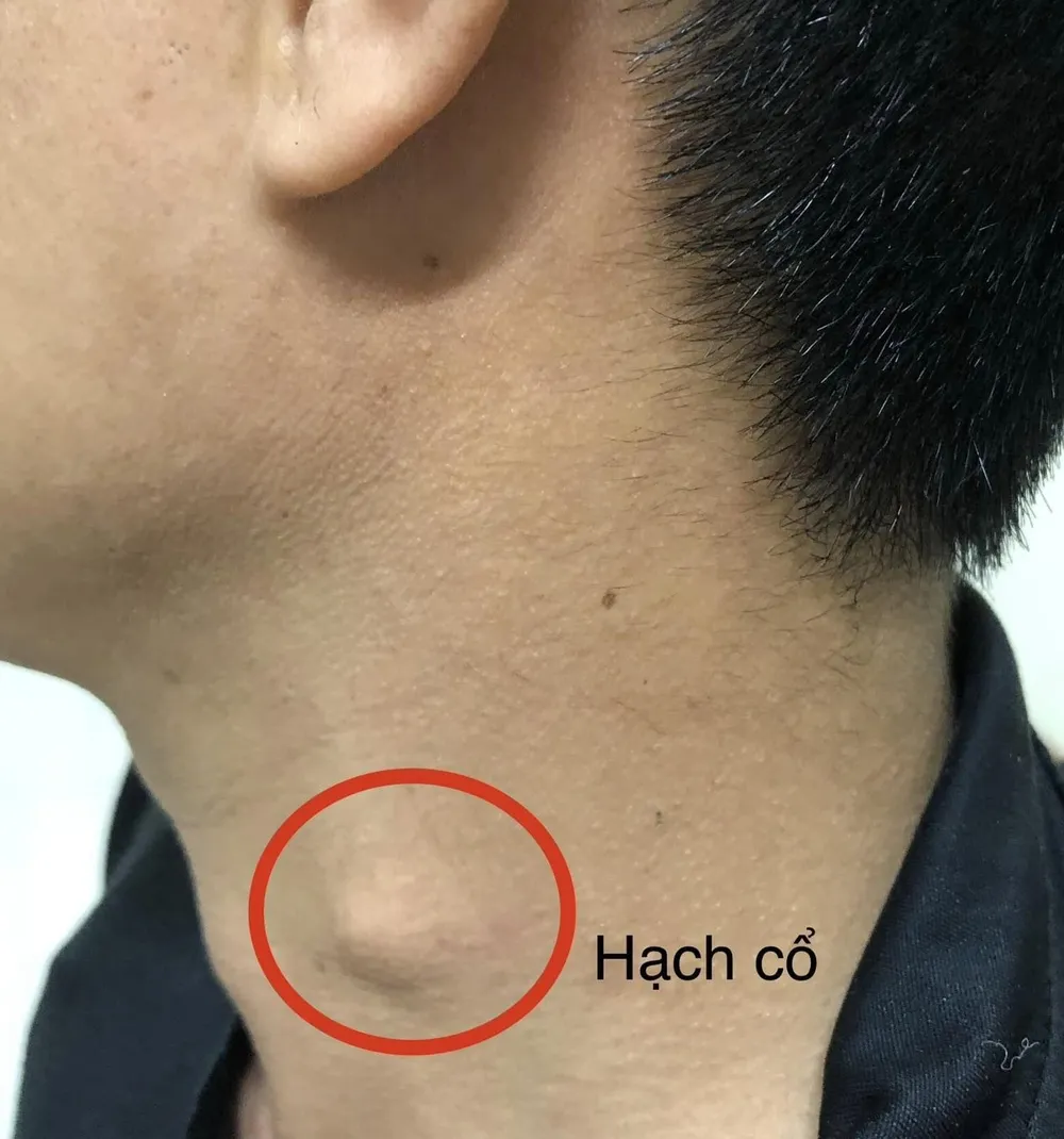 Dần dần, bệnh nhân xuất hiện hạch cổ, không còn ăn được cơm. Ảnh: BVCC ung thư thực quản.jpg