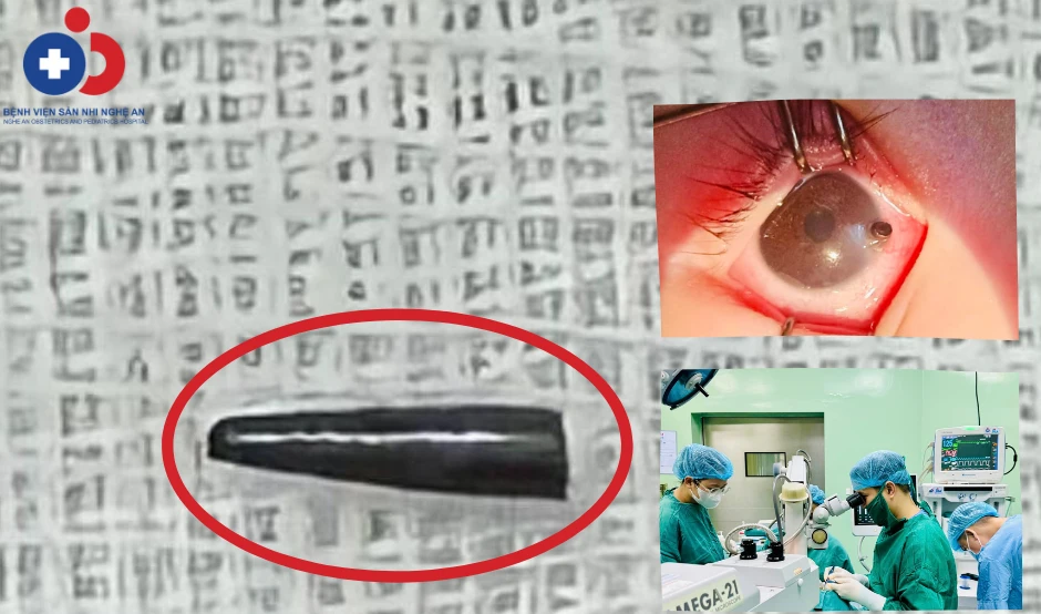 thủng nhãn cầu.png