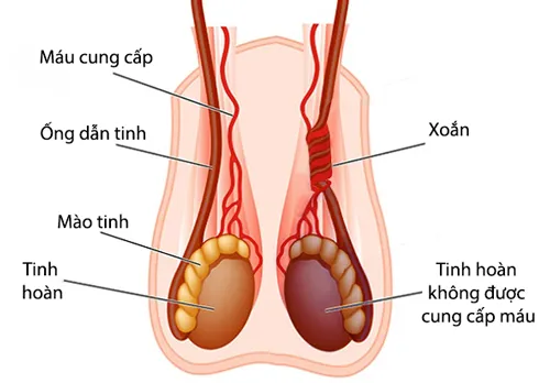 Số ca bệnh nhập viện với chẩn đoán xoắn tinh hoàn có chiều hướng tăng. Ảnh minh họa xoắn tinh hoàn ở trẻ em.png