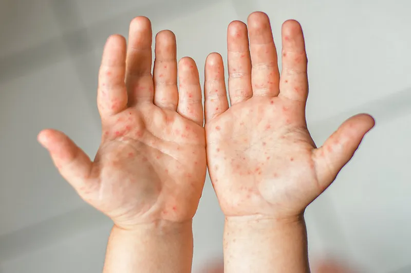 Sở Y tế Hà Nội nhận định thời gian tới là cao điểm dịch tay chân miệng. Ảnh minh họa tay chân miệng.jpg