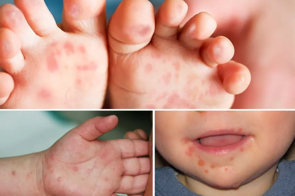Thời điểm giao mùa có thể ảnh hưởng đến sự gia tăng của dịch bệnh tay chân miệng và các bệnh truyền nhiễm khác. Ảnh minh họa bệnh tay chân miệng.png