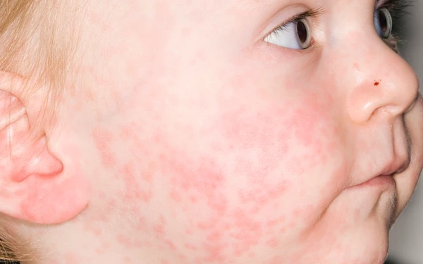 Bệnh sởi có tốc độ lây nhiễm rất cao. Ảnh minh họa vaccine sởi.png